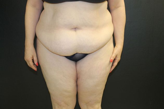 Abdominoplasty Case 18 - Before