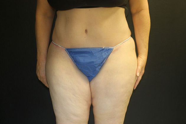 Abdominoplasty Case 18 - After