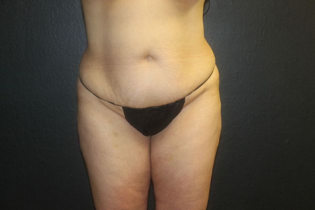Abdominoplasty Case 19 - Before