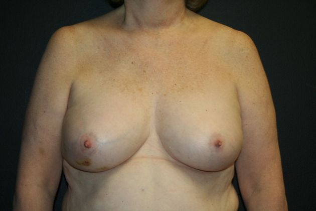 Breast Reconstruction: Case 13 - Before