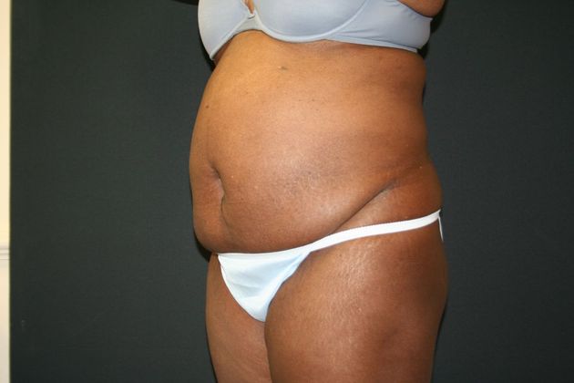 Abdominoplasty Case 20 - Before