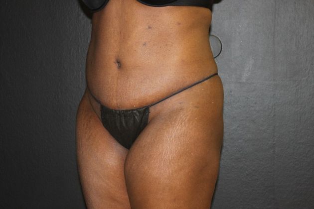 Abdominoplasty Case 20 - After