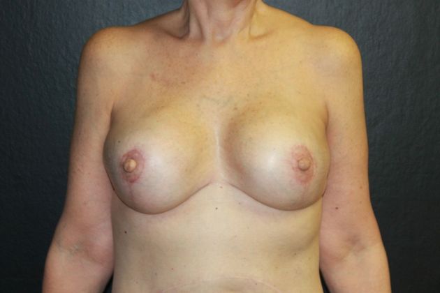 Breast Reconstruction: Case 14 - After