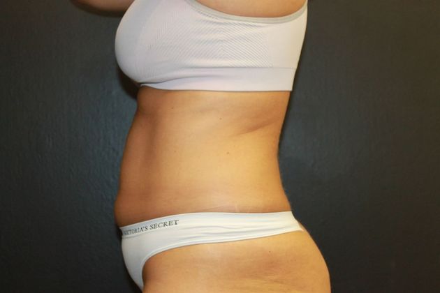 CoolSculpting®: Case 9 - Before