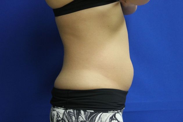 CoolSculpting®: Case 10 - Before
