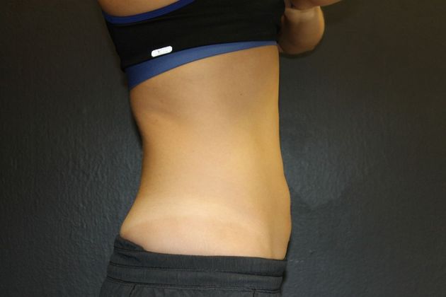 CoolSculpting®: Case 10 - After