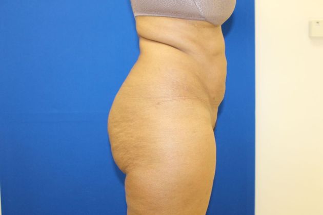 Brazilian Butt Lift: Case 4 - Before