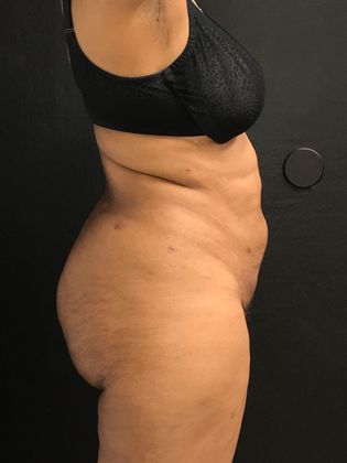 Brazilian Butt Lift: Case 4 - After