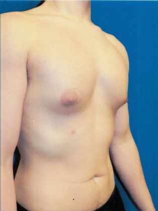 Male Breast / Gynecomastia: Case 5 (20725) - Before