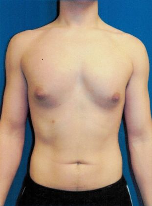 Male Breast / Gynecomastia: Case 5 (20725) - Before