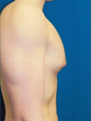 Male Breast / Gynecomastia: Case 5 (20725) - Before