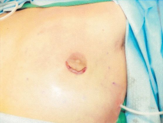 Male Breast / Gynecomastia: Case 5 (20725) - Left chest, during surgery, gland removed, small incision