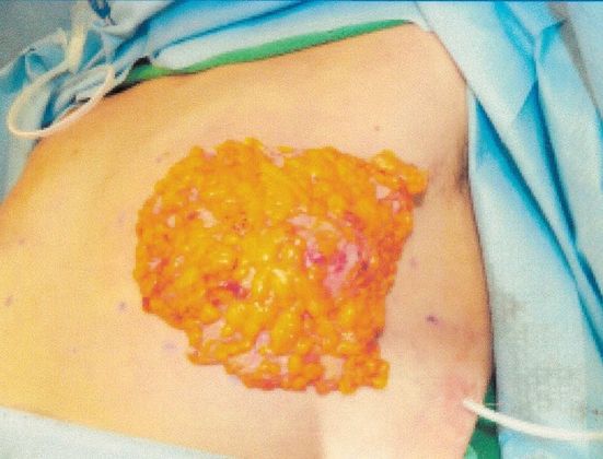 Male Breast / Gynecomastia: Case 5 (20725) - Same view, specimen placed over removal site.