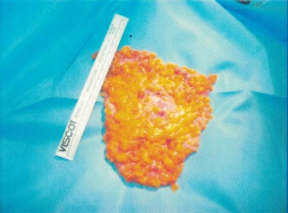 Male Breast / Gynecomastia: Case 5 (20725) - Size of gland removed