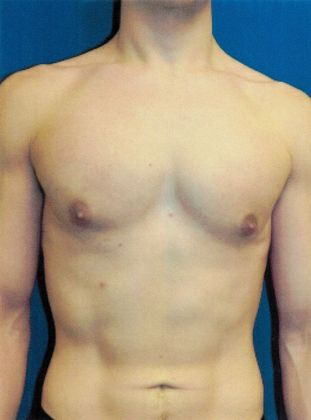 Male Breast / Gynecomastia: Case 5 (20725) - After
