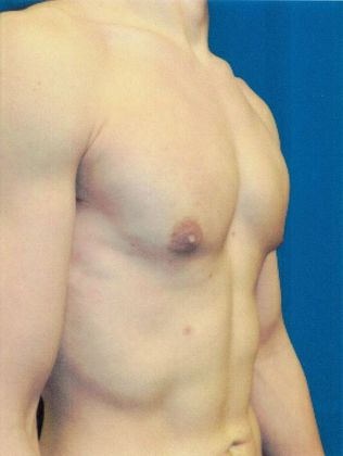 Male Breast / Gynecomastia: Case 5 (20725) - After