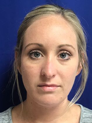 Injectables Minimally-Invasive / Fillers: Case 13 - Before