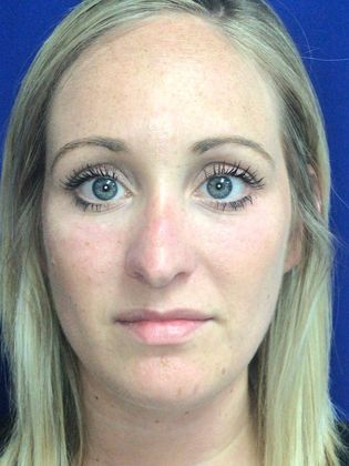 Injectables Minimally-Invasive / Fillers: Case 13 - After