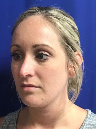 Injectables Minimally-Invasive / Fillers: Case 13 - Before