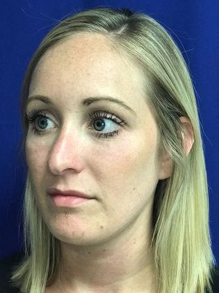 Injectables Minimally-Invasive / Fillers: Case 13 - After