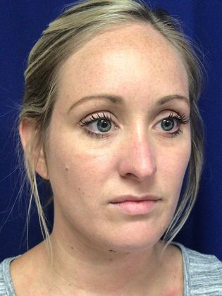 Injectables Minimally-Invasive / Fillers: Case 13 - Before