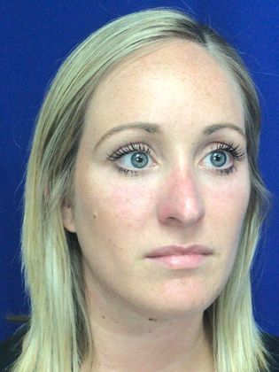 Injectables Minimally-Invasive / Fillers: Case 13 - After