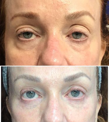 Injectables Minimally-Invasive / Fillers: Case 14 (08582) - Before above, after below, frontal view