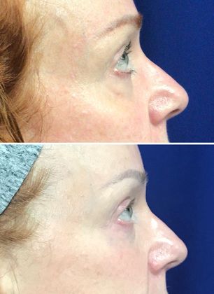 Injectables Minimally-Invasive / Fillers: Case 14 (08582) - Before above, after below, lateral view