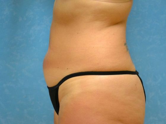 Tummy Tuck: Case 1675- Toledo, OH - Before