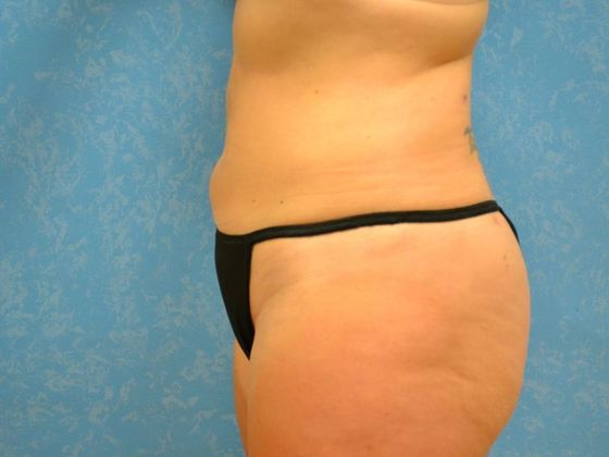 Tummy Tuck: Case 1675- Toledo, OH - After