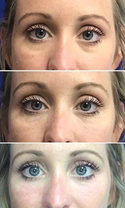 Injectables Minimally-Invasive / Fillers: Case 13 - Before, interim, final