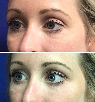 Injectables Minimally-Invasive / Fillers: Case 13 - Before, After