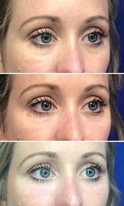 Injectables Minimally-Invasive / Fillers: Case 13 - Before, interim, final