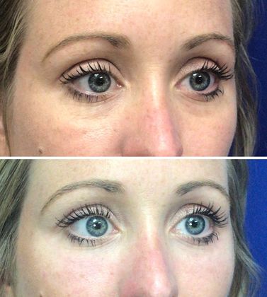 Injectables Minimally-Invasive / Fillers: Case 13 - Before above, After below