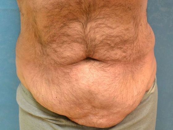 Tummy Tuck: Case 1676- Toledo, OH - Before