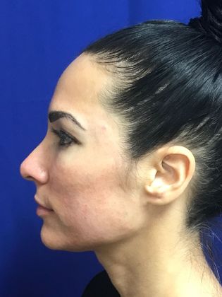 Injectables Minimally-Invasive / Fillers: Case 15 (22848) - After