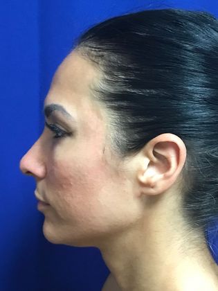 Injectables Minimally-Invasive / Fillers: Case 15 (22848) - Before