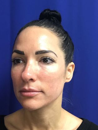 Injectables Minimally-Invasive / Fillers: Case 15 (22848) - Before