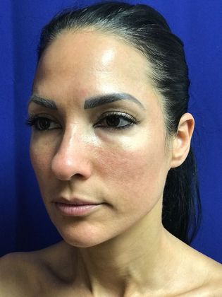 Injectables Minimally-Invasive / Fillers: Case 15 (22848) - After