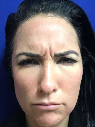 Injectables Minimally-Invasive / Fillers: Case 15 (22848) - Before