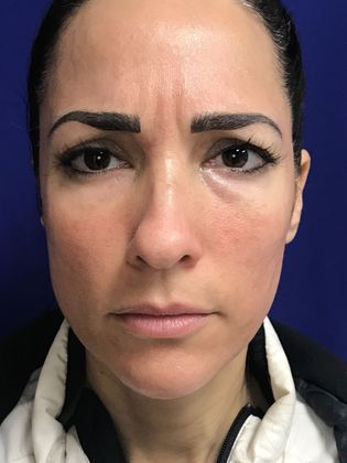 Injectables Minimally-Invasive / Fillers: Case 15 (22848) - After