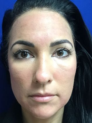 Injectables Minimally-Invasive / Fillers: Case 15 (22848) - Before