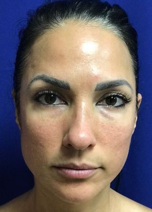 Injectables Minimally-Invasive / Fillers: Case 15 (22848) - After