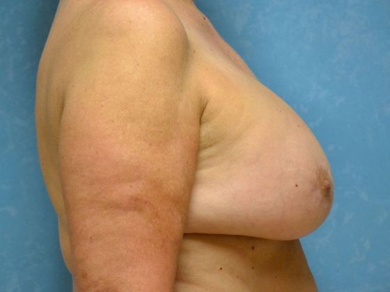 Breast Augmentation: Case 1768- Gibsonburg, OH - After