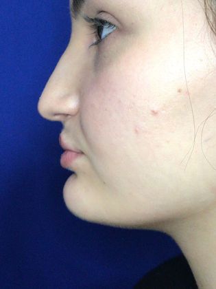 Injectables Minimally-Invasive / Fillers: Case 16 (23031) - After, upper lip projection & fullness