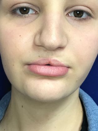 Injectables Minimally-Invasive / Fillers: Case 16 (23031) - Before, resting