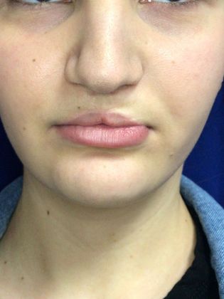 Injectables Minimally-Invasive / Fillers: Case 16 (23031) - After, resting