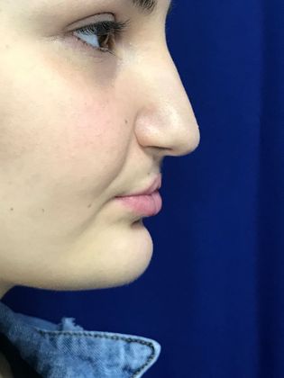 Injectables Minimally-Invasive / Fillers: Case 16 (23031) - Before, lacking upper lip projection
