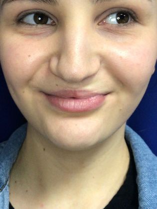 Injectables Minimally-Invasive / Fillers: Case 16 (23031) - Before, smiling 