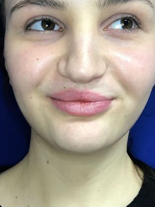 Injectables Minimally-Invasive / Fillers: Case 16 (23031) - Better smile symmetry after Volbella